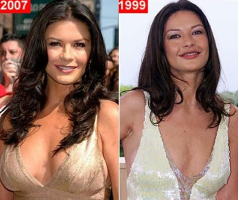 catherine zeta jones plastic surgery